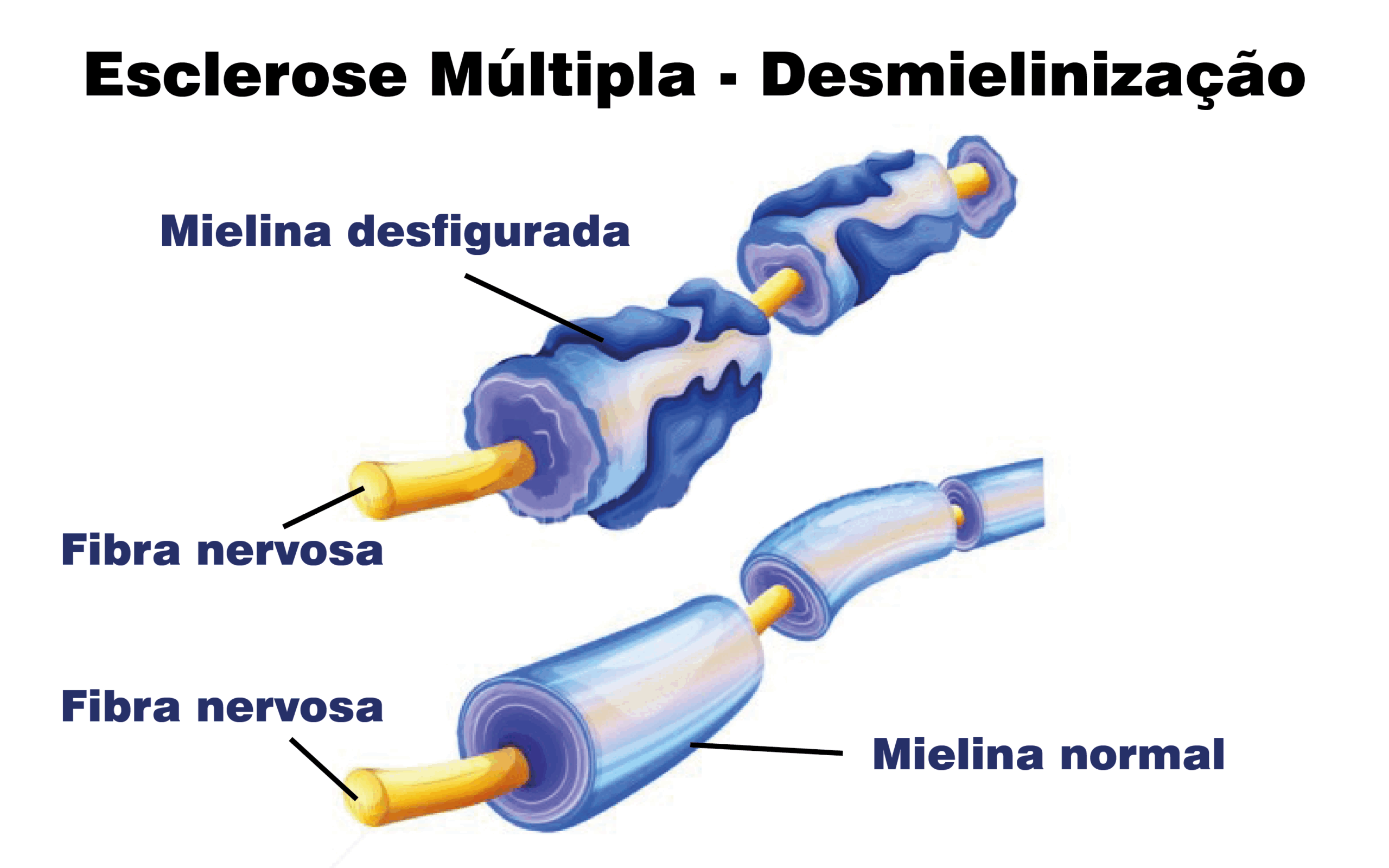 ESCLEROSE MÚLTIPLA - Clínica Dr. Rocha